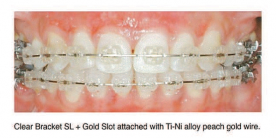 DentoSmile Sankin Clear Bracket