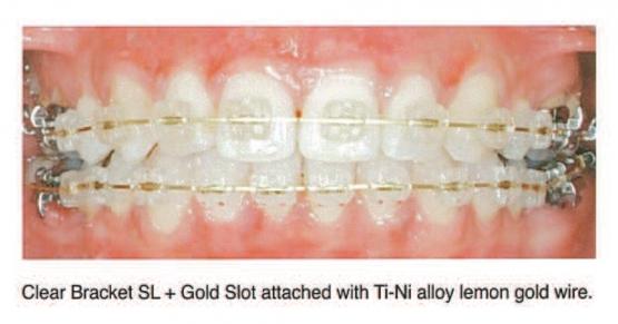 DentoSmile Sankin Clear Bracket