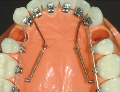 Dentos Korea Crimpable Hook