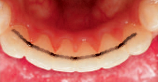Stainless Steel Ortho FlexTech® Dental Retention System