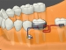 Bracket Head (Right handed screw)