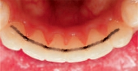 Stainless Steel Ortho FlexTech® Dental Retention System